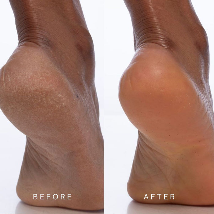 Before and after comparison of a heel and foot when using a body creme.